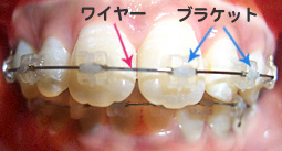U期治療ではワイヤーやブラケットを使った治療を行います。
