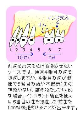 インプラント矯正 状態の良くない歯を抜かなくてはいけなかった場合