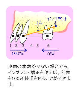 インプラント矯正 固定源となる奥歯の本数が少ない場合