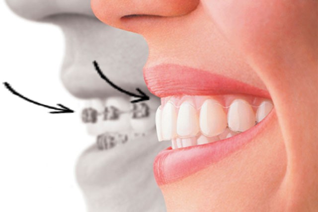 インビザラインの効果や期間ってどう 出っ歯は治せないの クローバー歯科 矯正歯科医監修コラム