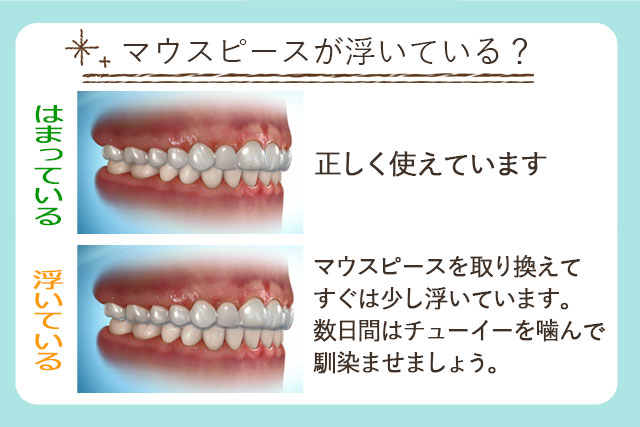 チューイー アライナー 歯科材料通販フィード｜アライナーチューイー（Dentsply Sirona