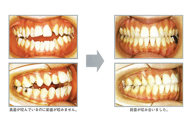 子供の歯並び かみ合わせが深い かみ合わない すきっ歯 大阪矯正歯科グループ