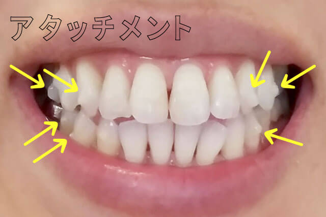 歯 列 矯正 やら なきゃ よかった 大人の歯列矯正で感じる後悔 経験者の声ってどんなもの Stg Origin Aegpresents Com