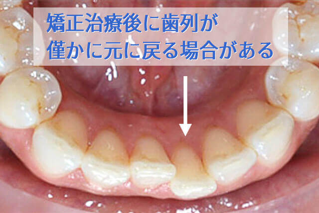 歯列矯正 後戻り 10年: 歯列矯正後 戻ってきた _ 歯列矯正 後戻り 10年の動画 – PIMEM