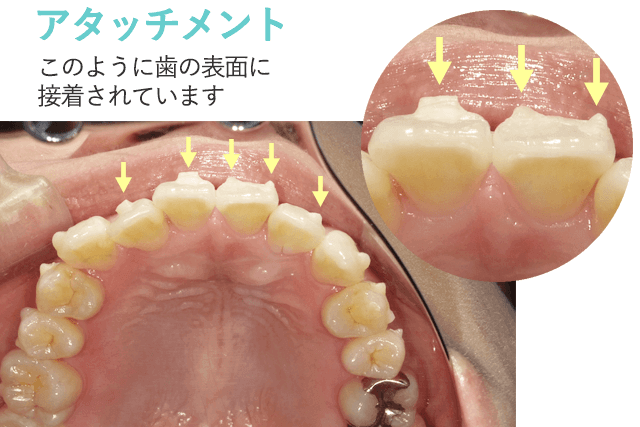 アタッチメントの説明