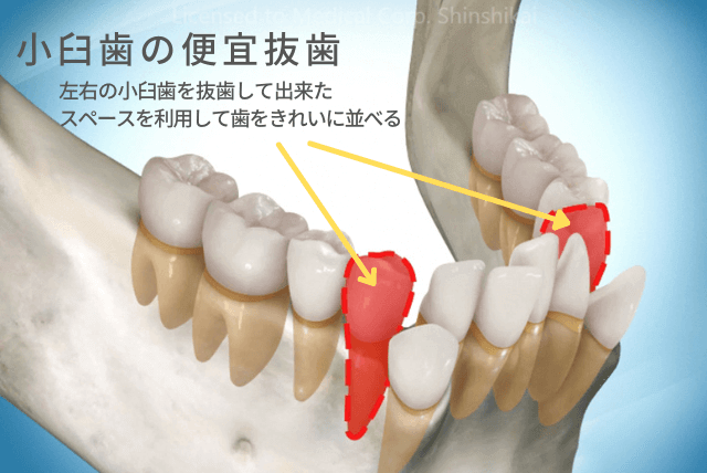 小臼歯の抜歯