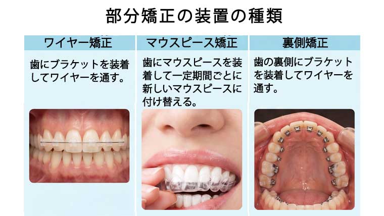 部分矯正の装置の種類
