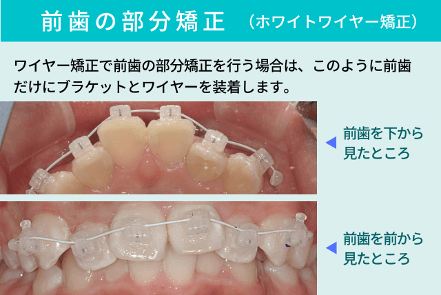 部分矯正（ホワイトワイヤー矯正）