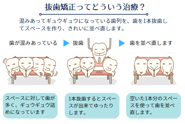 抜歯矯正ってどういう治療？