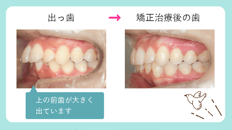 出っ歯の症例