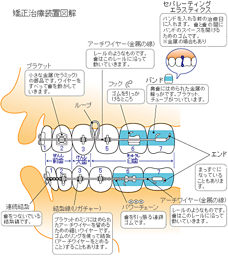 ワイヤー矯正の図解