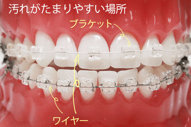 汚れがたまりやすい場所はワイヤーとブラケット