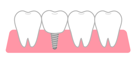 インプラント