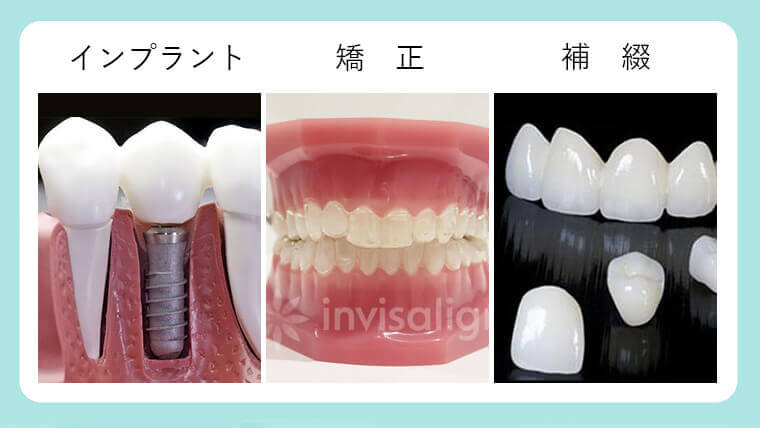 インプラント、矯正、補綴