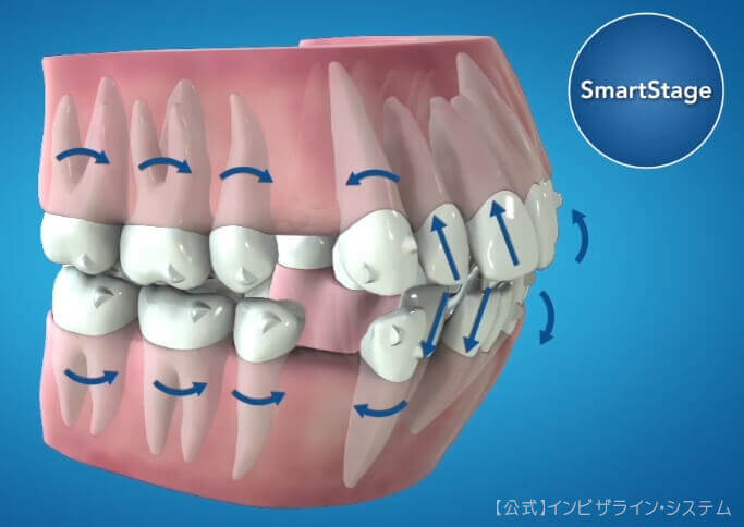 インビザラインアタッチメント