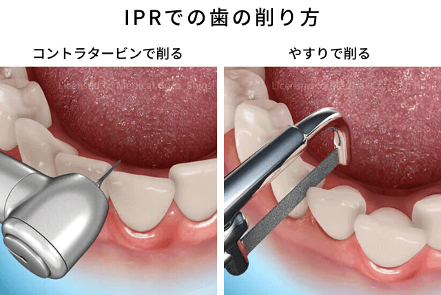 IPRでの歯の削り方