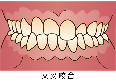 交叉咬合