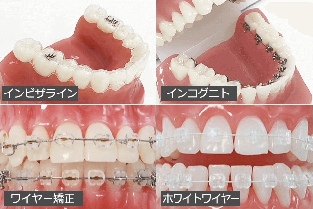 矯正治療種類