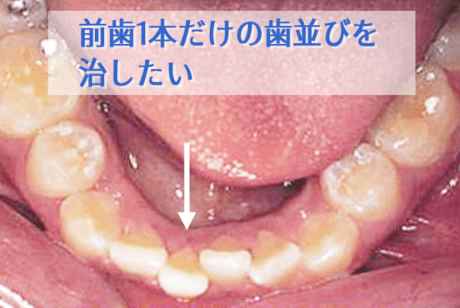 前歯1本だけ歯並びを治したい