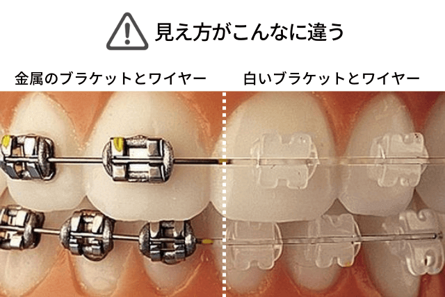 金属と白のブラケットとワイヤー