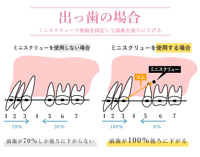 出っ歯の場合の抜歯矯正の図