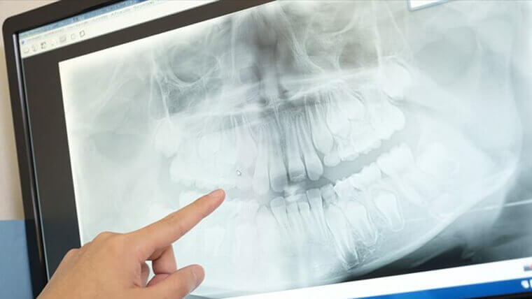 乳歯の生え変わりのレントゲン写真