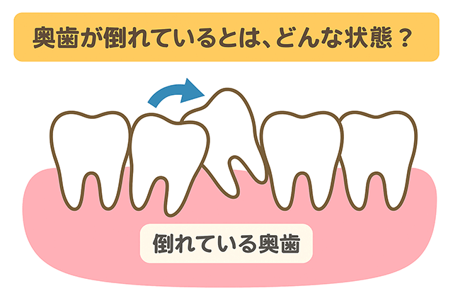 奥歯が倒れている