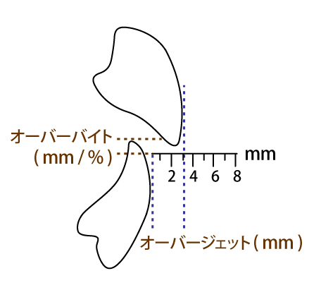 オーバーバイトとオーバージェット