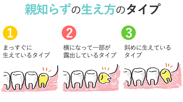 親知らずの生え方のタイプ