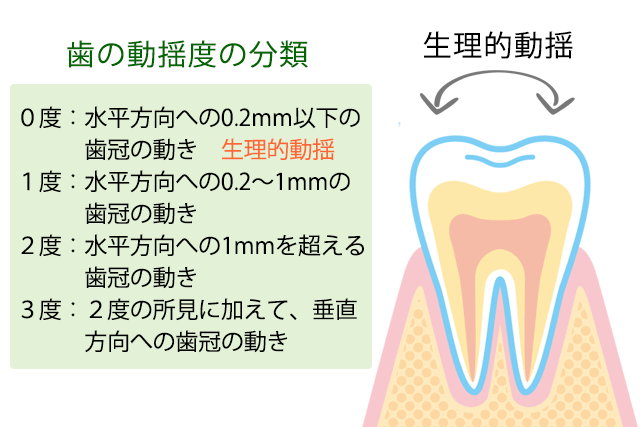 歯の動揺殿分類