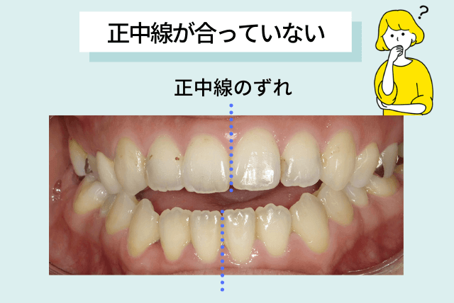 正中線画合っていない・ずれている