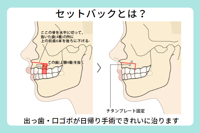 セットバックとは？