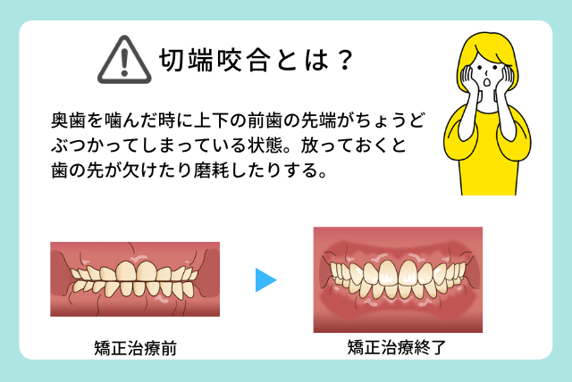 切端咬合とは