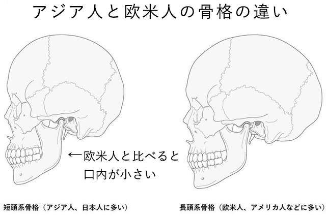 アジア人と欧米人の骨格の違い