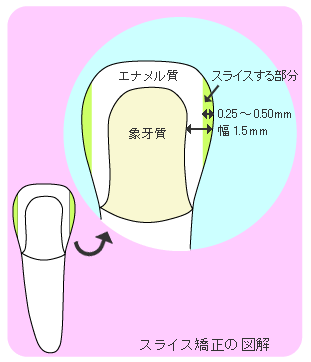 スライス矯正（ディスキング）