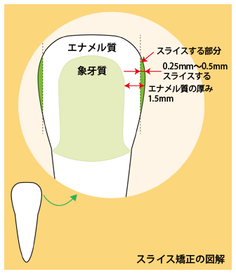 スライス矯正