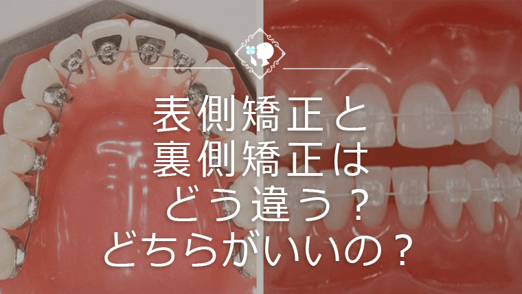 表側矯正と裏側矯正はどう違う？どちらがいいの？