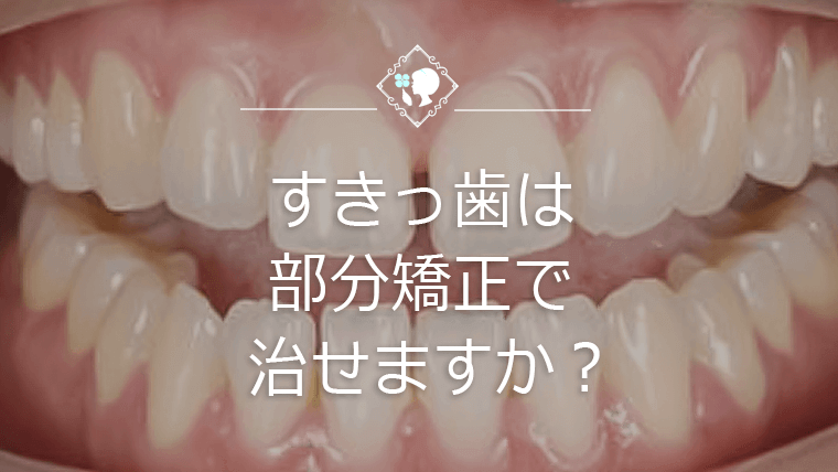 すきっ歯は部分矯正で治せますか？