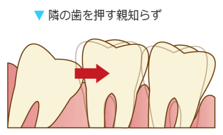 隣の歯を押す親知らず