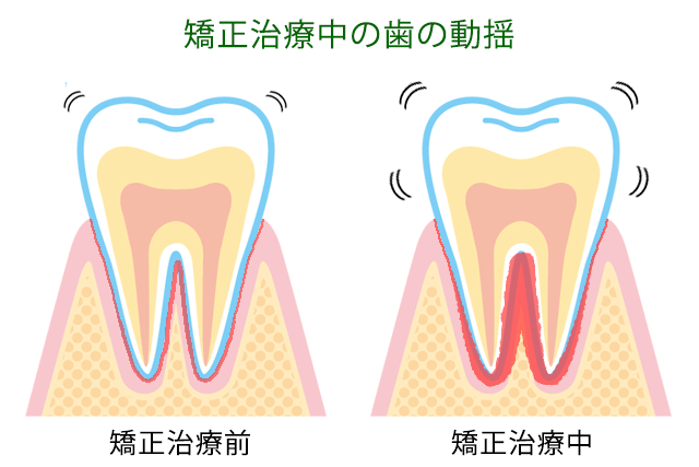 矯正治療中の歯の動揺