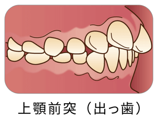 上顎前突（出っ歯）