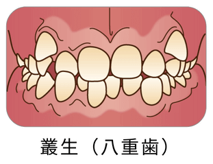 叢生（八重歯）