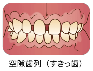 空隙歯列（すきっ歯）