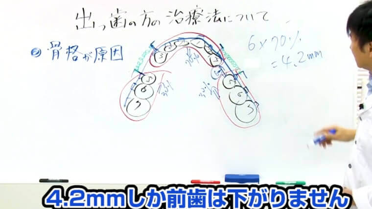 出っ歯の治療で4.2ミリしか前歯が下がらない説明