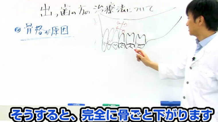 セットバック整形をすると完全に出っ歯が骨ごと下がる