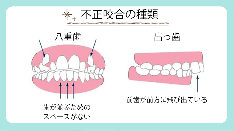 出っ歯と八重歯