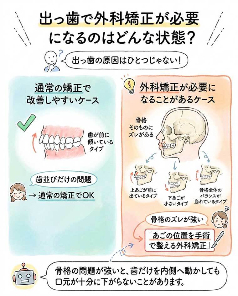 出っ歯で外科矯正が必要になるのはどんな状態？の図解