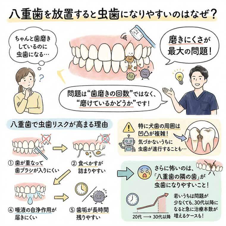 八重歯を放置すると虫歯になりやすいのはなぜ？の図解