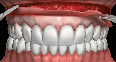 唇と歯の間の粘膜の部分を切除