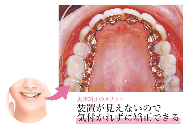 装置が見えないので気づかれずに矯正できる